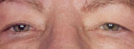 Before Blepharoplasty